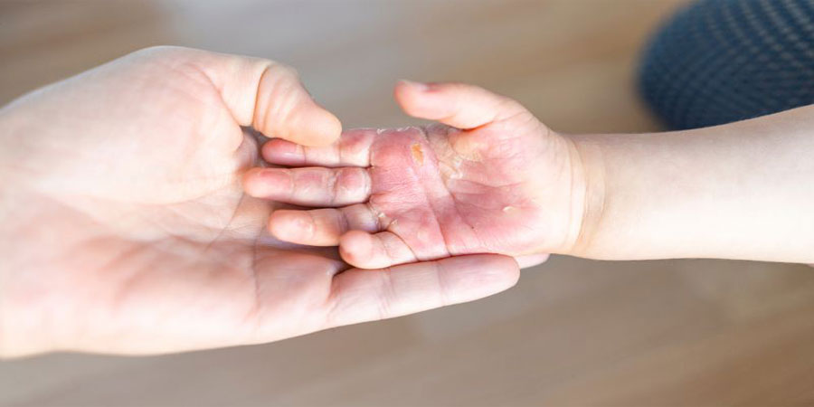 Nằm mơ thấy bị bỏng đánh lô như thế nào cho hợp lý?